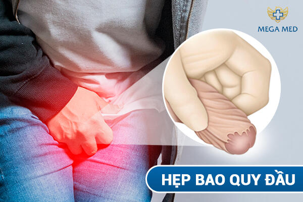 Hẹp bao quy đầu